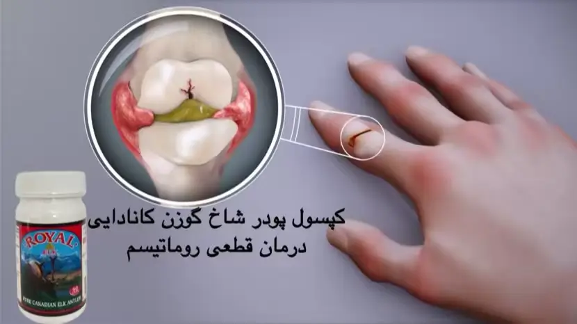 علت روماتیسم