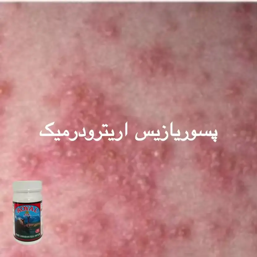 پسوریازیس اریترودرمیک